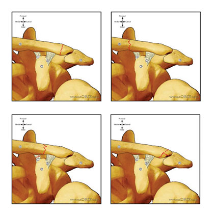 Distal clavicle fracture classification