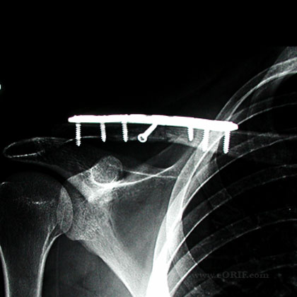 Clavicle Fracture ORIF Case 1 | eORIF