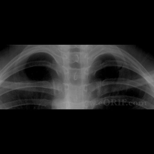 Rib fracture xray