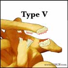 Type V AC separation