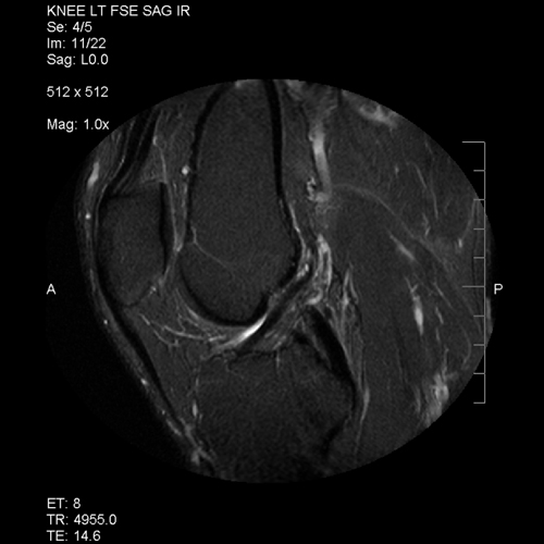 Normal ACL mri