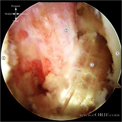 ACL reconstruction image