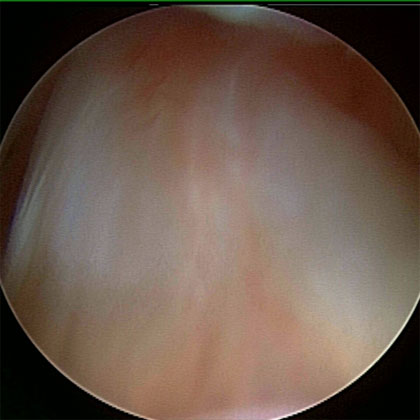 arthroscopic ACL picture