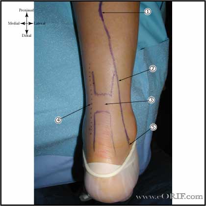 Achilles Approach Anatomy