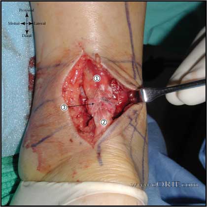 Achilles repair picture