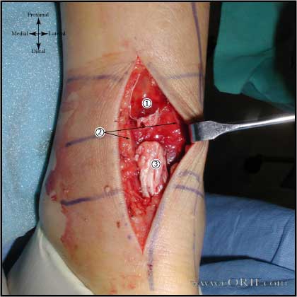 Achilles Approach Anatomy