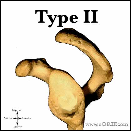 Type II Acromion