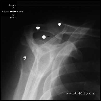 Subacromial impingement xray