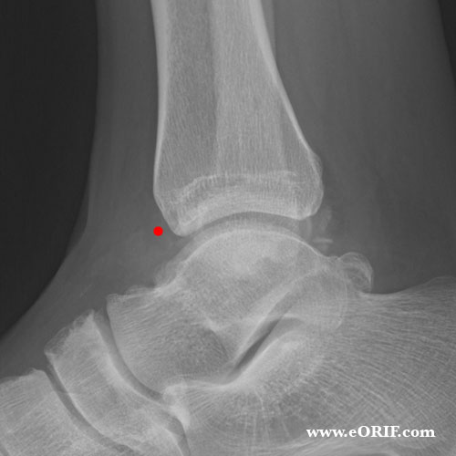 Anterior ankle impingement xray