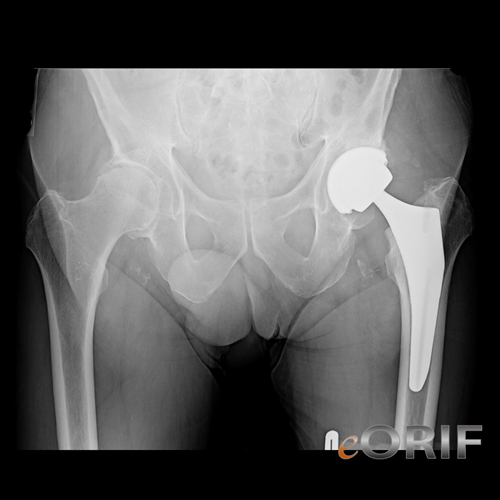 anterior approach THA xray