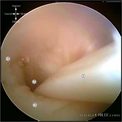 biceps tendon arthroscopic picture