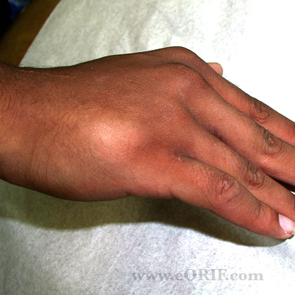 Metacarpal fracture malunion photo