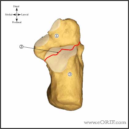 Calcaneous Primary Fracture Line Image