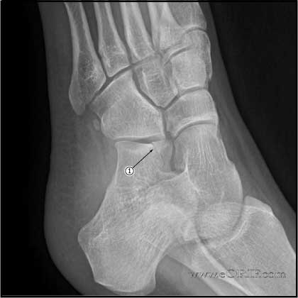 Anterior process calcaneus fracture xray