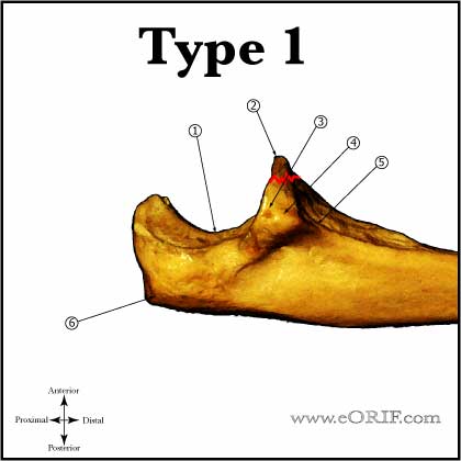 Type I Coronoid Fracture