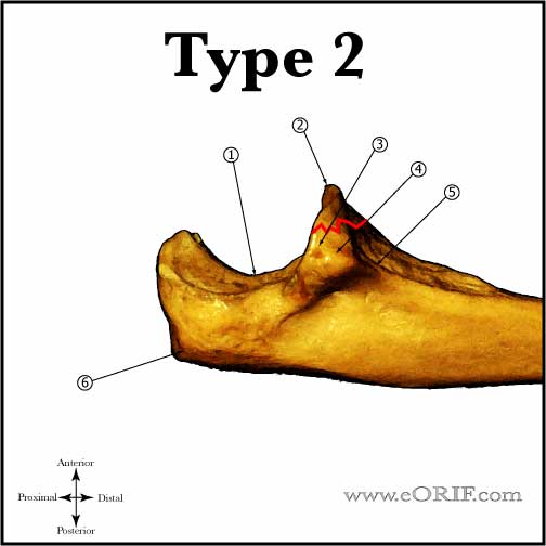 Type II Coronoid Fracture