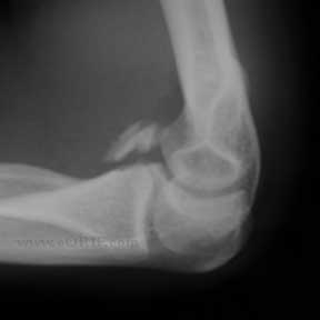 Type III coronoid fracture xray