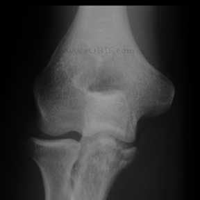 Type III coronoid fracture xray