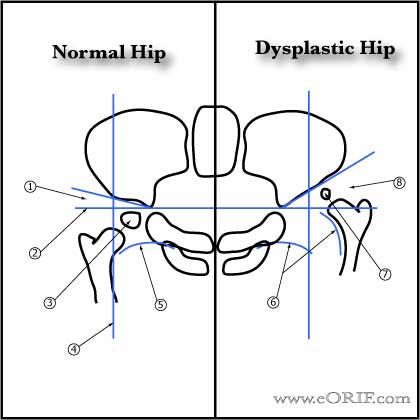 DDH xray landmarks