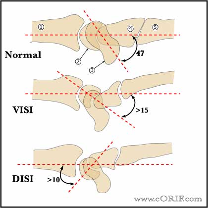 DISI and VISI image