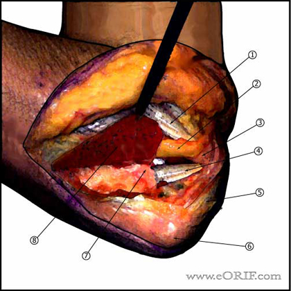 elbow Posteromedial Approach 