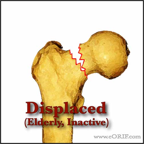 Displaced fermoral neck fracture