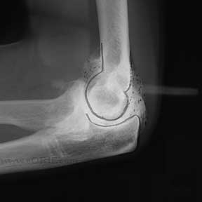 elbow arthritis xray