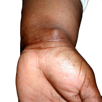 Volar wrist ganglion cyst image