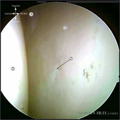 glenoid arthoscopy