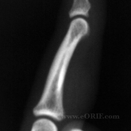 giant cell tumor lateral xray