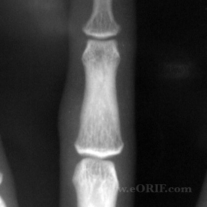 Giant cell tumor xray