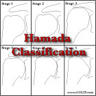 Hamada Classification of RTC tear