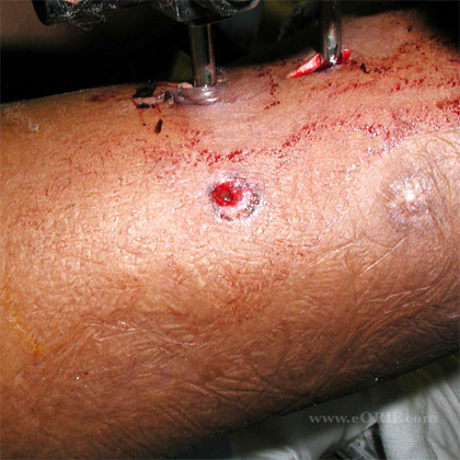 Humeral shaft gun shot entrance wound