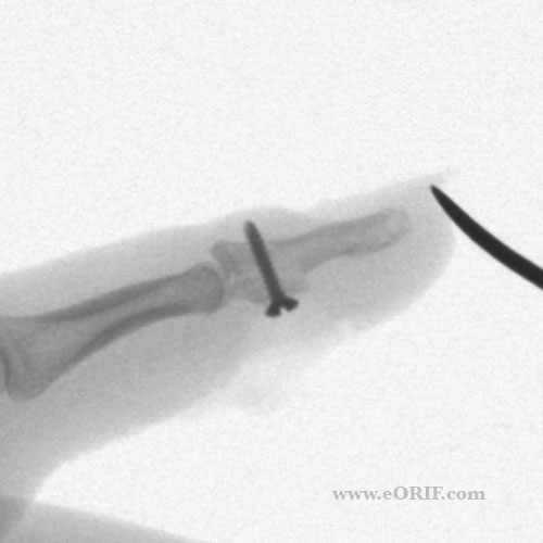 Boney Jersey finger xray