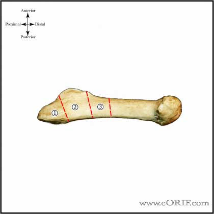 Jones Fracture classification image 