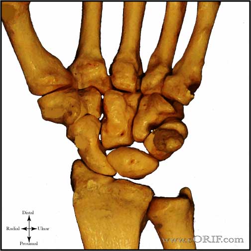 Kienbocks disease stage 1