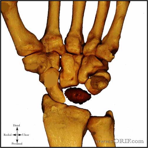 Kienbocks Disease Stage 3B