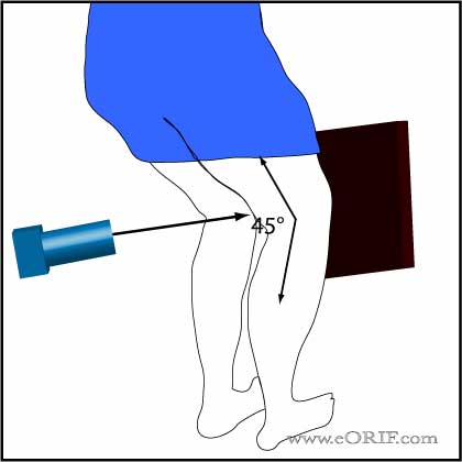 Weight-Bearing P/A (Rosenberg) view