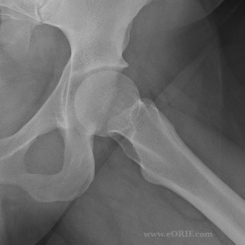 normal femail hip xray