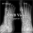 Lisfranc NWB xray