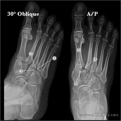 lisfranc injury xray