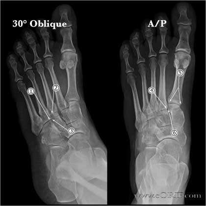 Lisfranc joint normal xrays