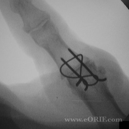 Thumb MCP arthrodesis xray