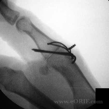 Thumb MCP arthrodesis