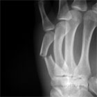 Metacarpal shaft fracture xray