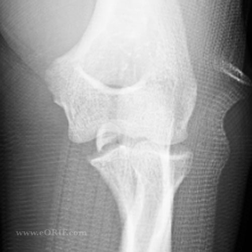 medial epicondyle fracture xray