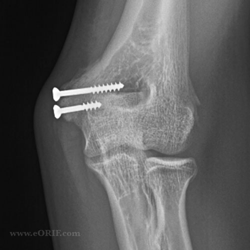 medial epicondyle fracture ORIF xray