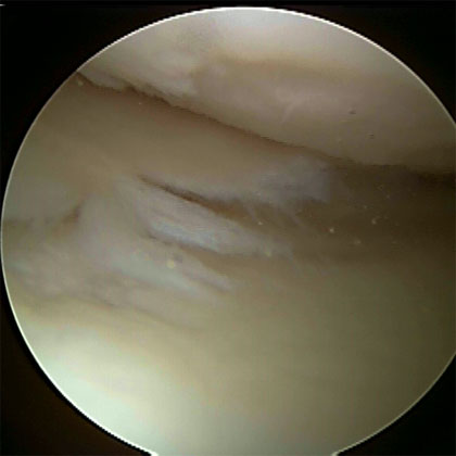 Complex / Degenerative Meniscal Tear 