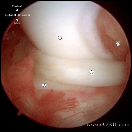 Bucket Handle Meniscal Tear 