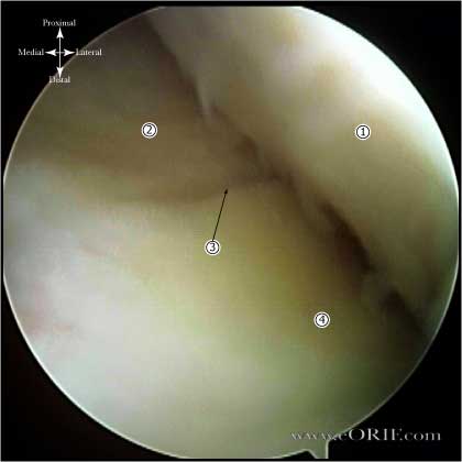 Longitudinal Meniscal Tear 